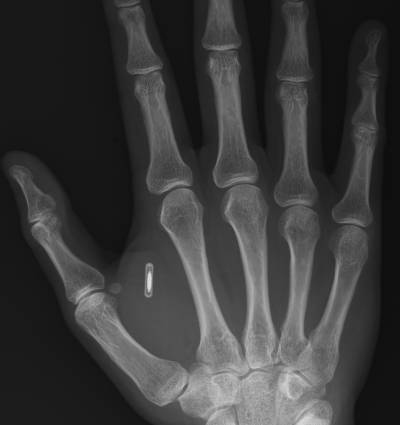 RFID имплантант в руке человека